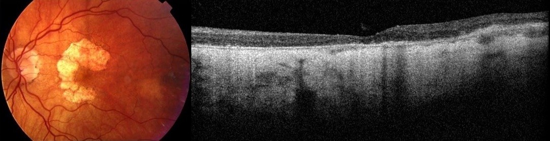 Atrophic change around the central macula