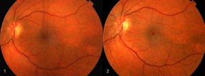 Full Thickness Macular Holes - Retina & Eye Consultants