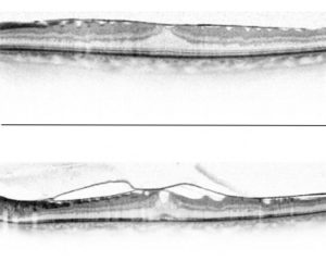 Epiretinal Membrane - Retina & Eye Consultants