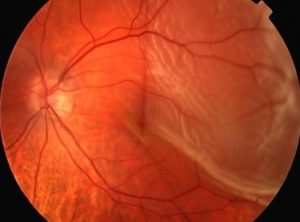 Retinal Detachment - Retina & Eye Consultants