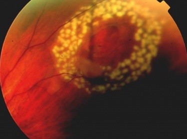 Laser treatment to a retinal tear