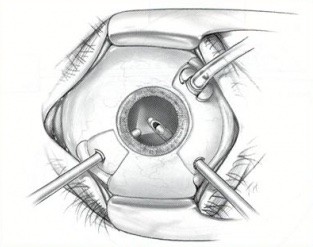 Vitrectomy procedure